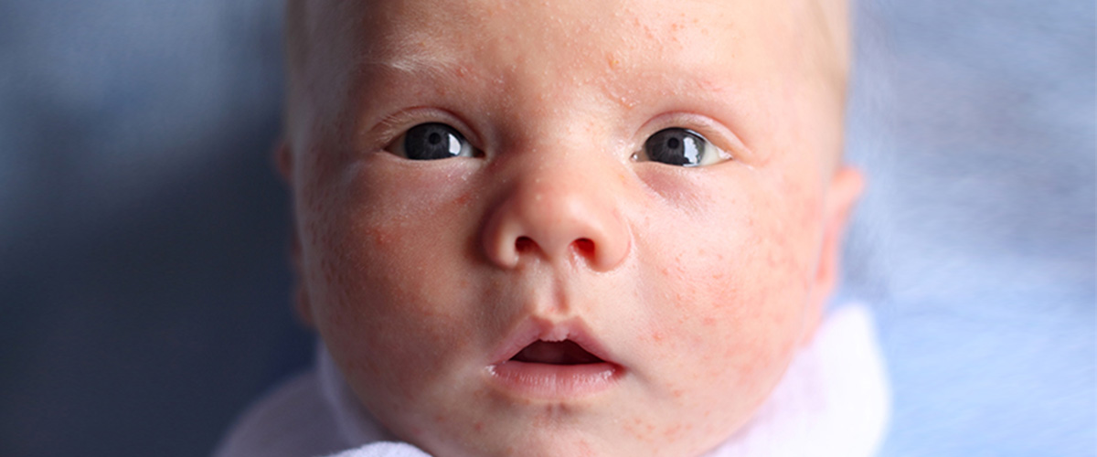 baby face with acne 