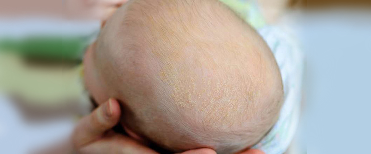 cradle cap 